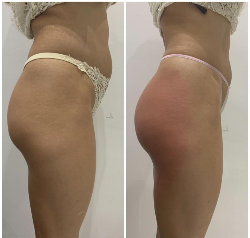 Non-Invasive Butt Lift Treatment in Malaysia