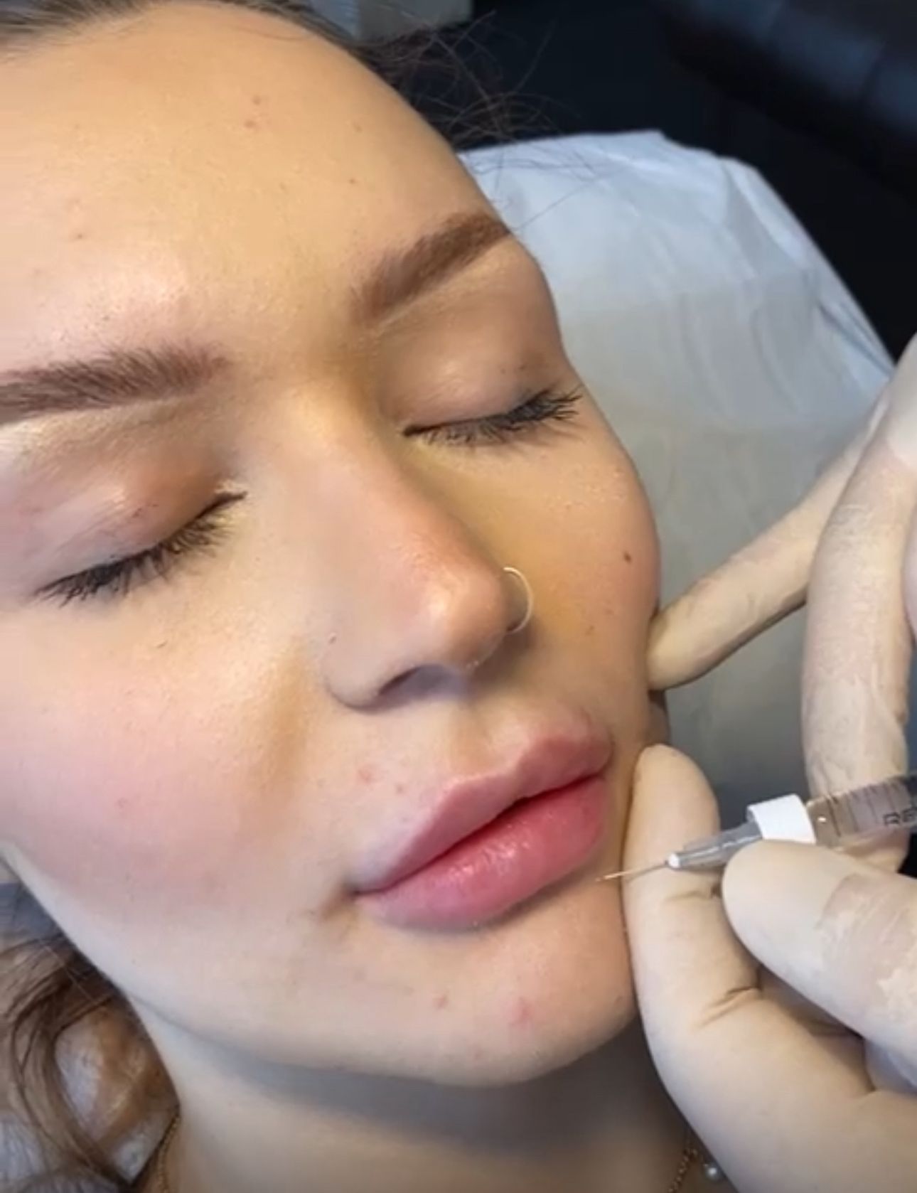lip filler advanced training course